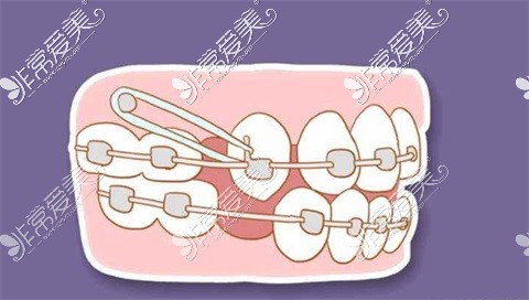 牙齿矫正图