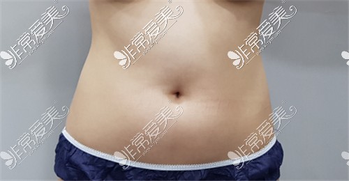 LINE&VIEW整形外科腹部吸脂术前图