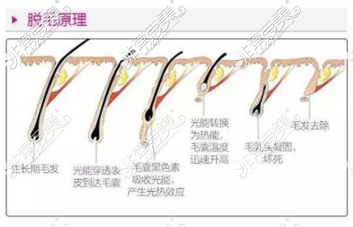 脱毛原理示意图