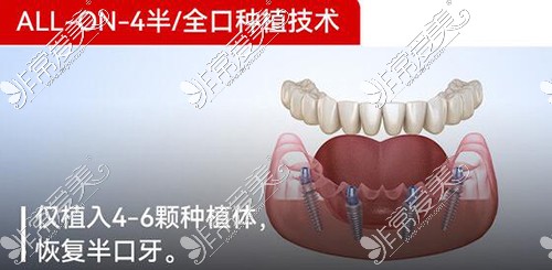 广州柏德口腔种植牙