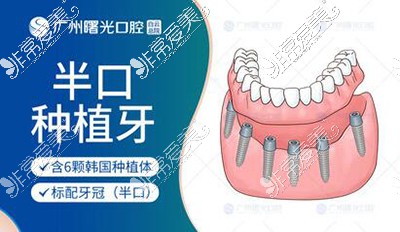 广州曙光口腔种植