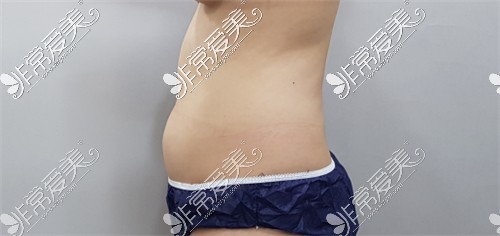 LINE&VIEW整形外科腰腹吸脂术前图