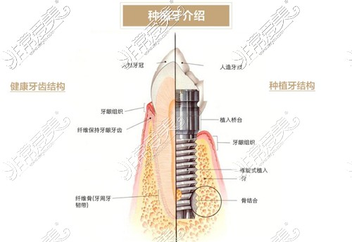 種植牙介紹圖