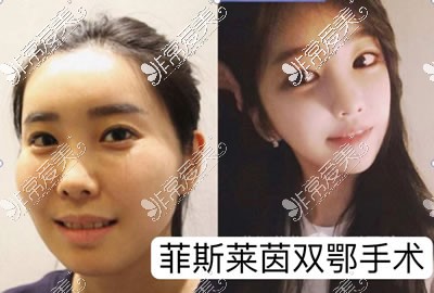韩国菲斯莱茵李真秀做双颚和面部轮廓手术特色价格分析