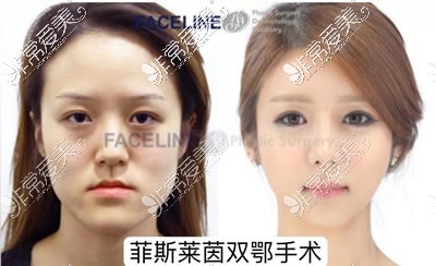 韩国菲斯莱茵李真秀做双颚和面部轮廓手术特色价格分析
