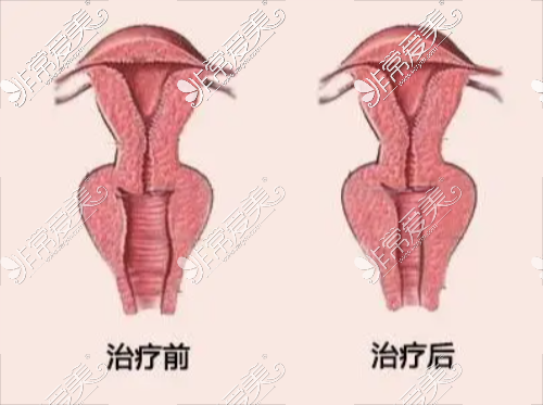 阴道紧缩术前术后