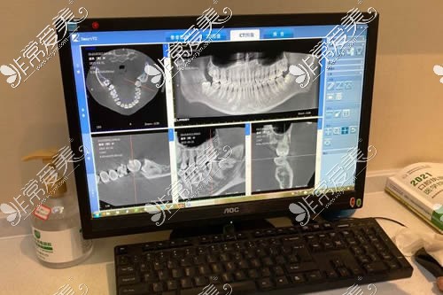 种植牙CT图片展示