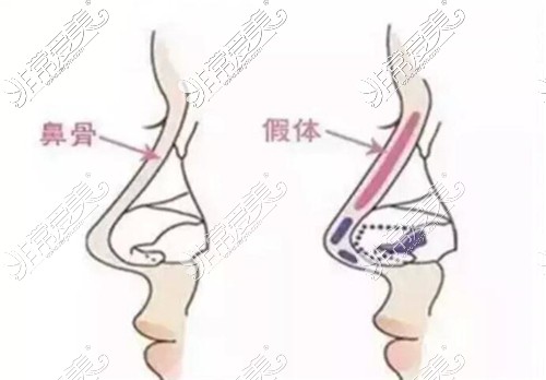 鼻整形方法示意图