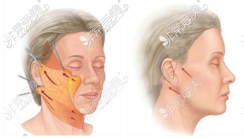 面部拉皮提升剥离面积和缝合位置