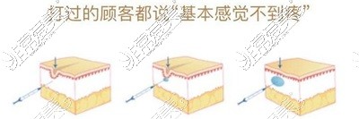 阿克苏唯星颜医疗美容注射除皱示意图