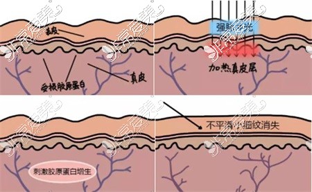 阿克蘇市人民醫(yī)院醫(yī)學(xué)美容科光子嫩膚圖