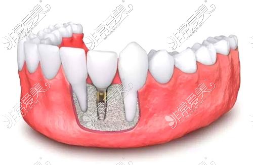 塔城牙科种植牙示意图