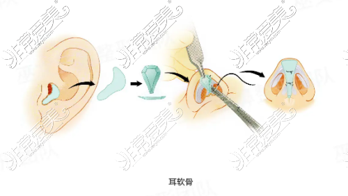 耳软骨垫鼻尖