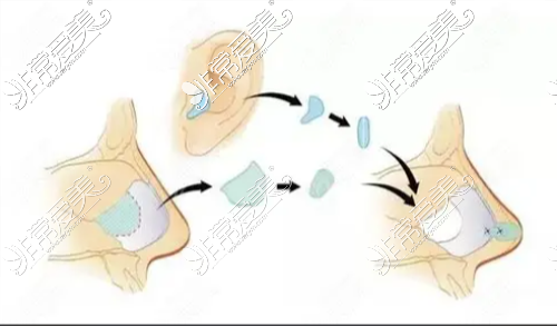 耳軟骨墊鼻尖