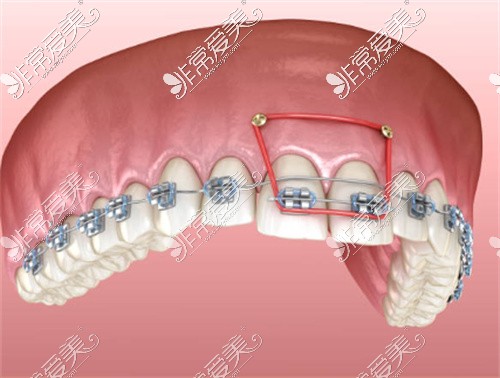 牙齿矫正示意图