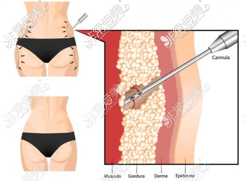 吸脂手術(shù)示意圖