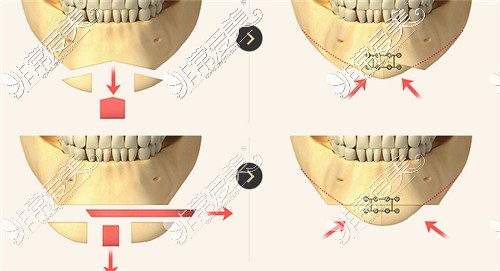 下巴手術(shù)方式圖