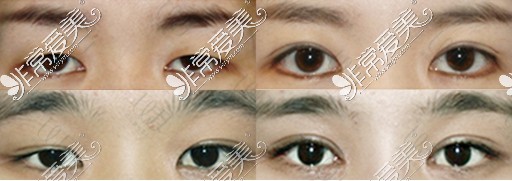 眼肌无力怎么改善?看韩国WJ原辰整形“眼肌矫正术”拯救你