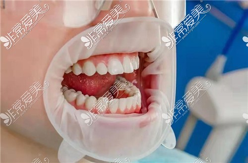 牙齿治疗操作期间图示