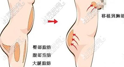 自體脂肪豐胸改善