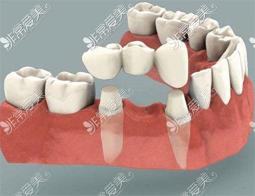 全瓷牙连桥冠图