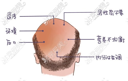 男性脱发原因