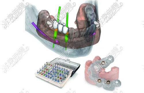 种植牙示意图