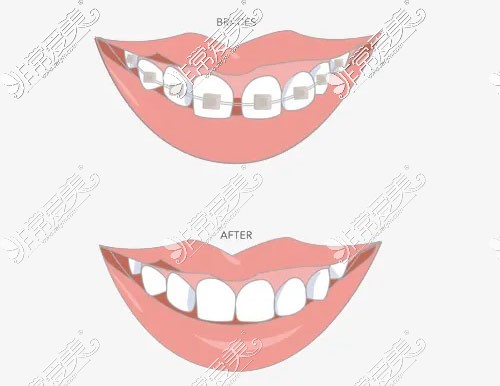 牙齿矫正图片