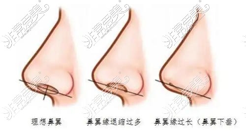 天生鼻子塌短丑想做隆鼻,在贵阳做鼻子要花多少钱哪家好