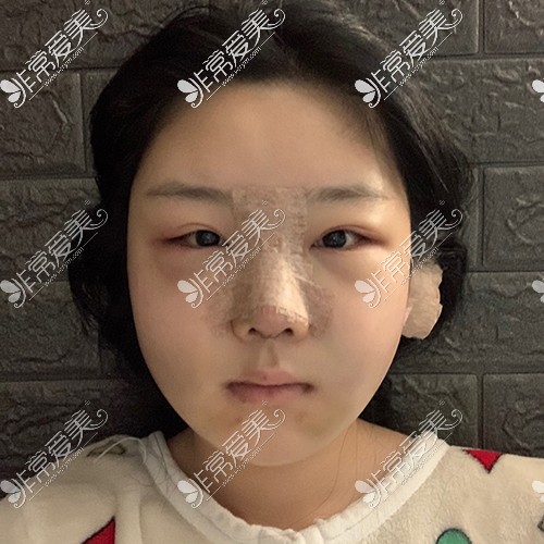 韩国脸本脸骨整形外科颧骨缩小+V型下颌角+鼻子再次手术+脂肪移植术后5天