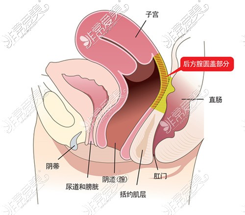 后方膣圆盖术