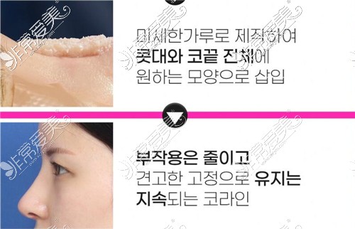 韩国wave整形外科隆鼻优势图