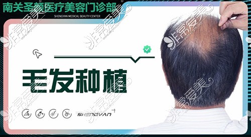 应对发际线后移问题，长春这几家医院发际线植发技术好！