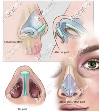 鼻尖下垂的提升方案