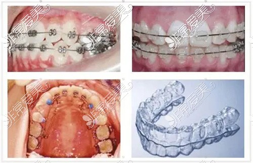 牙齿矫正种类