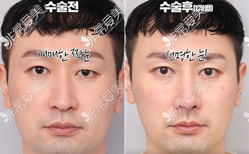 韩国迪美男生双眼皮前后图片