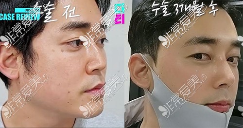 韩国哪里做男生双眼皮比较好 分享迪美男生双眼皮手术图片