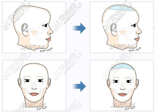 韩国雕刻整形外科头部美容整形对比