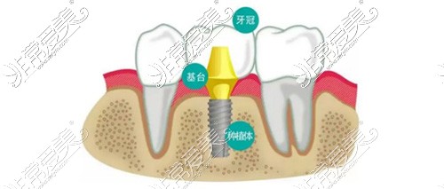 种植牙示意图