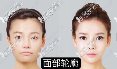 韩国改脸型多少钱？真人实例揭秘医院技术及收费标准