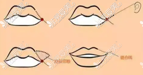 唇部整形方法示意图