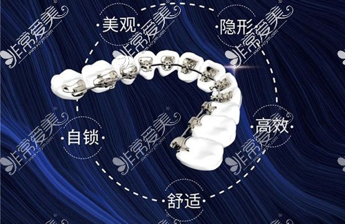 国产隐贝inbracket矫正器特点展示