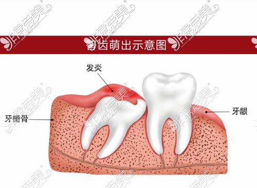 智齿萌出示意图