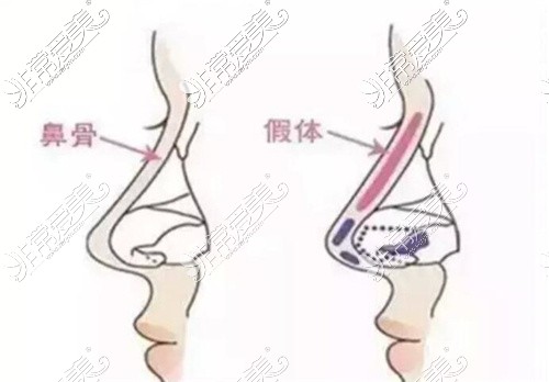 假体隆鼻前后示意图