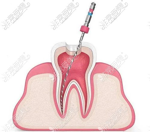 牙髓根管治疗图片