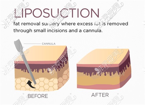 吸脂手术原理