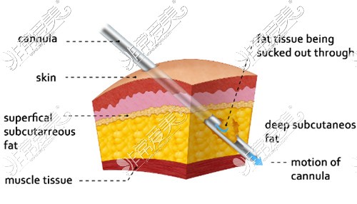 吸脂手术原理展示图