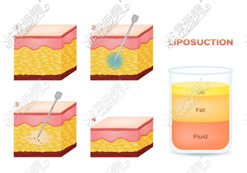 吸脂手术原理