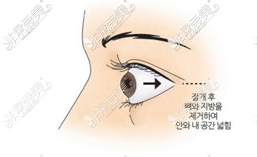 韩国突眼矫正医院可以改善眼球突出的问题,近视突眼有救了!