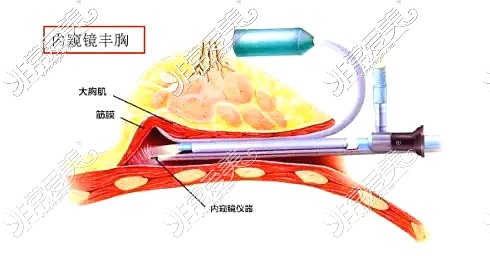 內(nèi)窺鏡隆胸示意圖